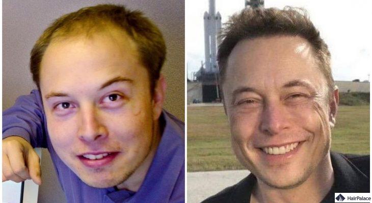 elon musk haartransplantation Ergebnis