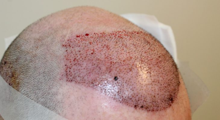 Dereks FUE2 Haarimplantation