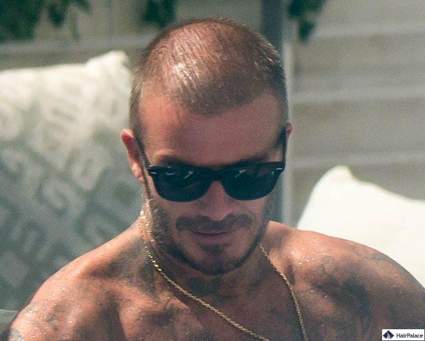 david-beckham-haarausfall