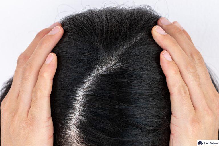 genetisch bedingter Haarausfall kann zu einen lichten, breiten Scheitel führen