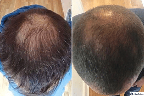 Stammzellen Haartransplantation Chirurgie