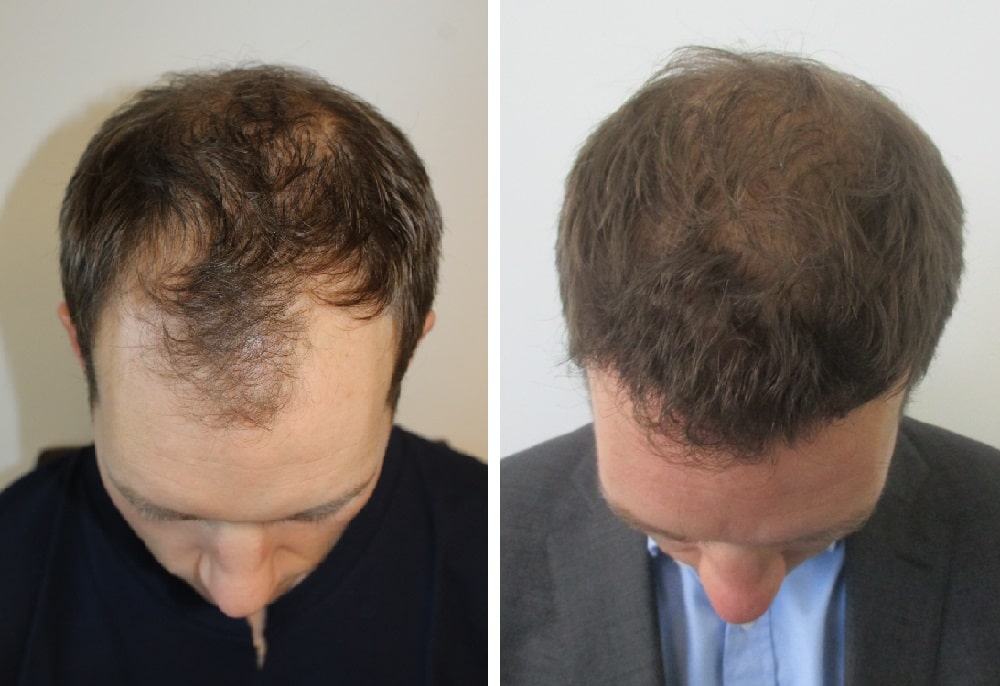 haartransplantation-mit-dichtem-ergebnis