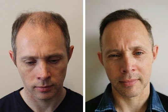 natuerliche-fue-haartransplantation-ergebnis