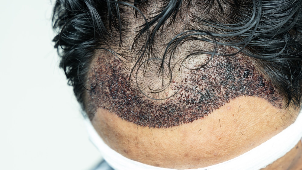 Infektion durch Haartransplantation