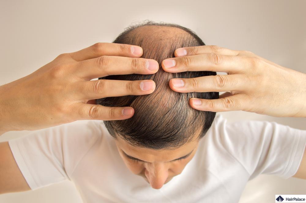 Lösungen für Haarverlust