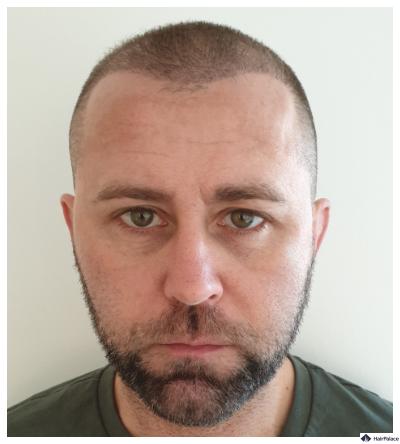 3-monate-nachher-haartransplantation