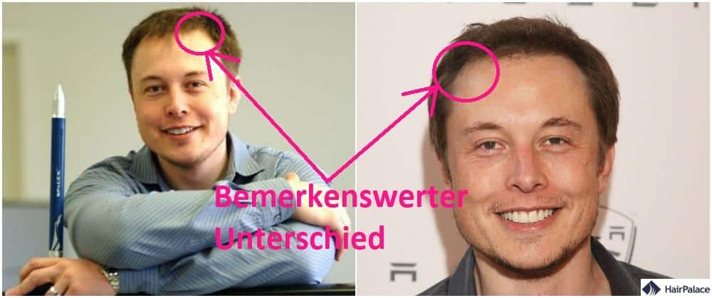 Haartransplantation bei Elon Musk im Jahr 2000