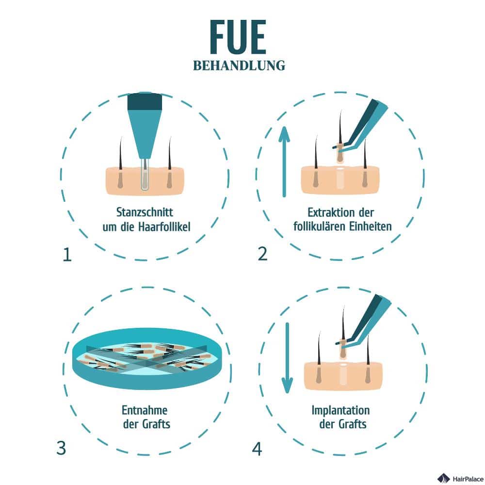 FUE-Haartransplantationen behandlung