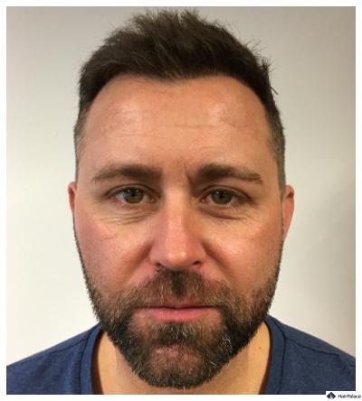 haartransplantation-resultat