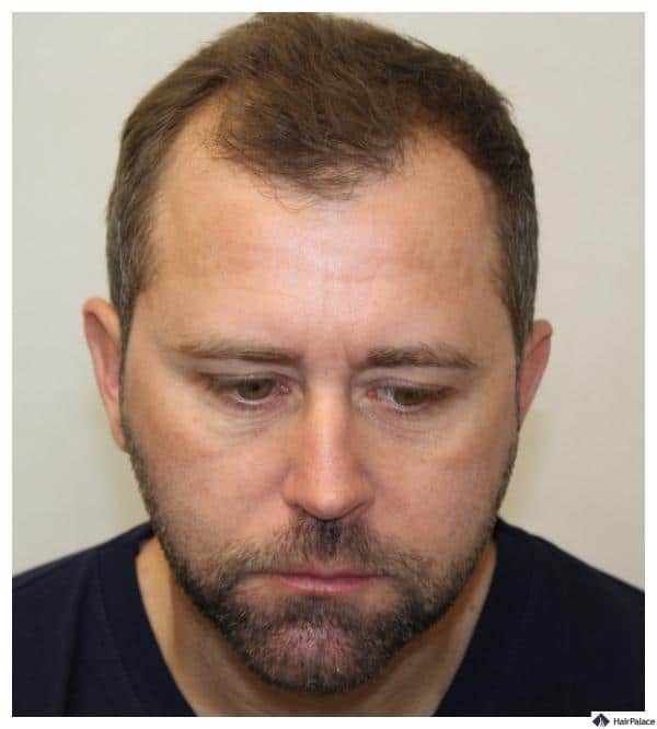 vorher-fue-haartransplantation