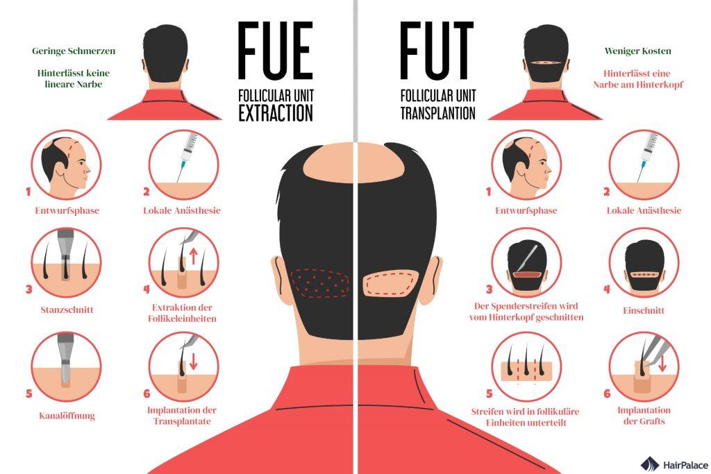 fue vs fut behandlung