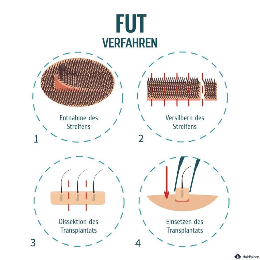 fut haartransplantation behandlung