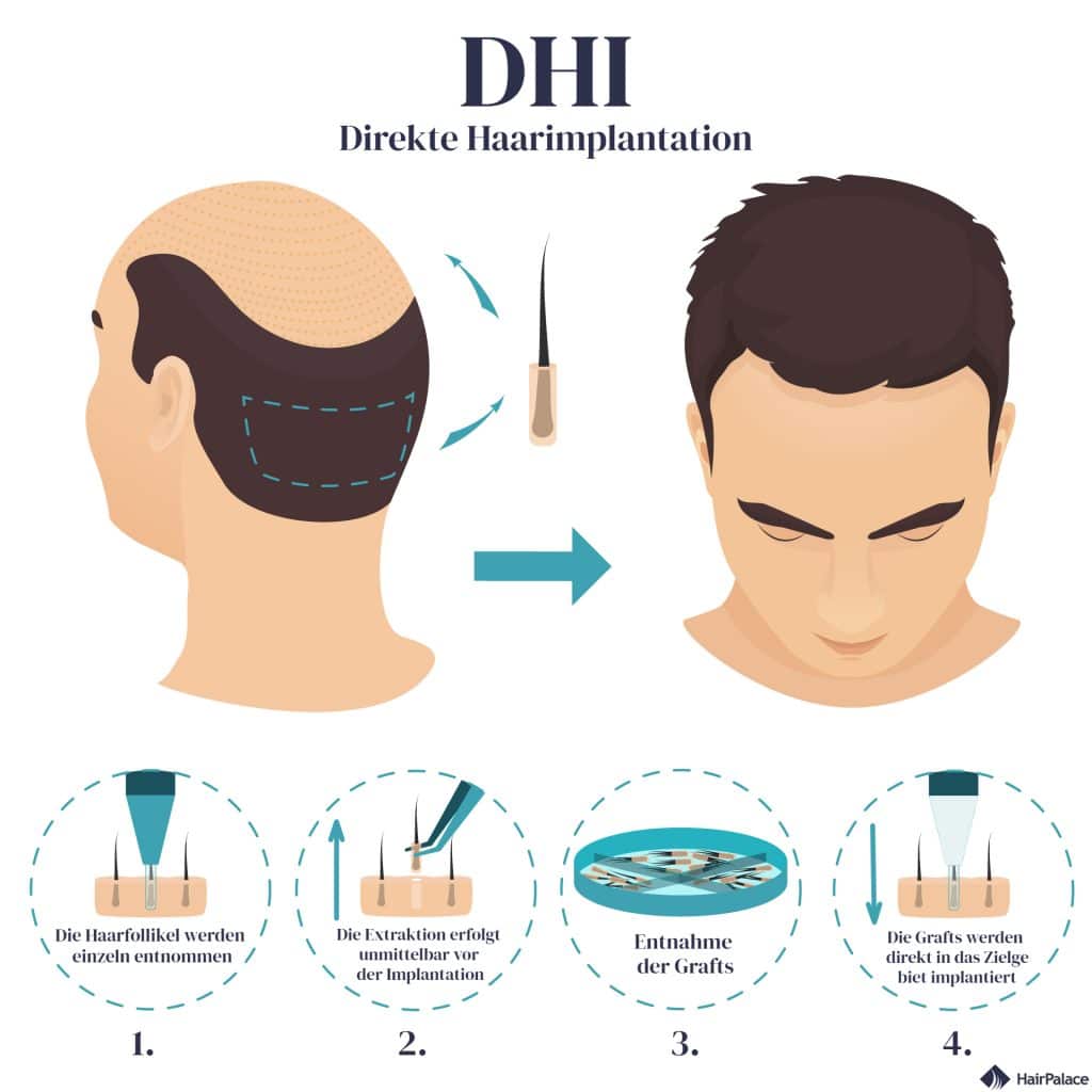 Was ist eine DHI-Haartransplantation