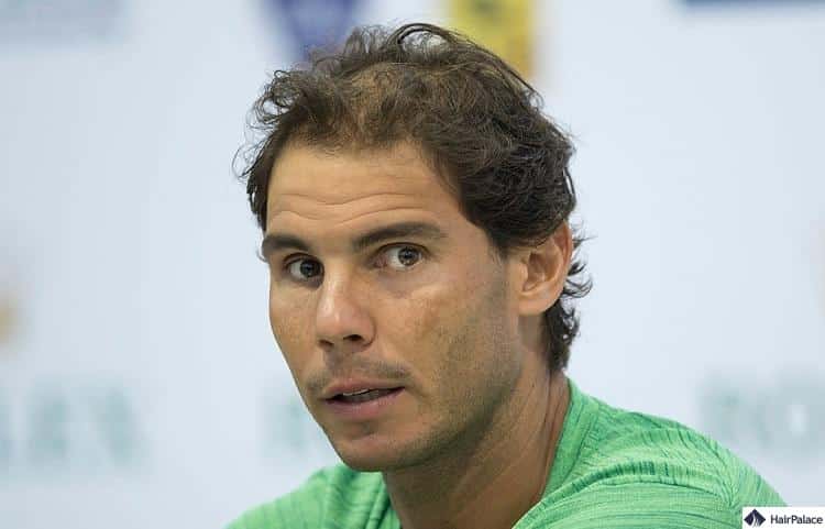 Rafael Nadal Haarverlust