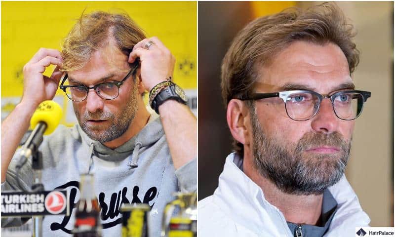 Jürgen Klopp Haartransplantation Ergebnisse