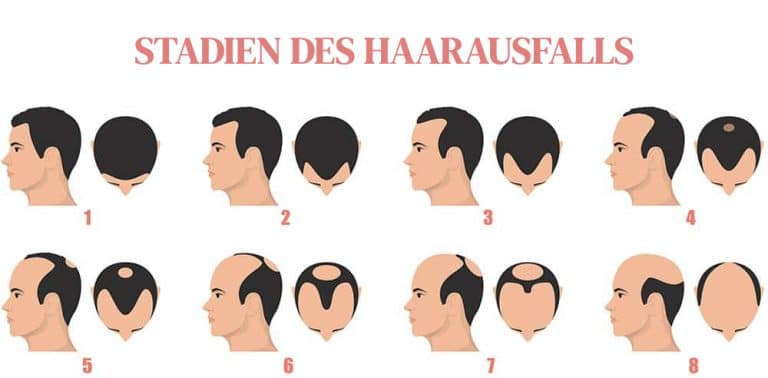 Haarausfall Männer: Ursachen und Behandlungen in 2025