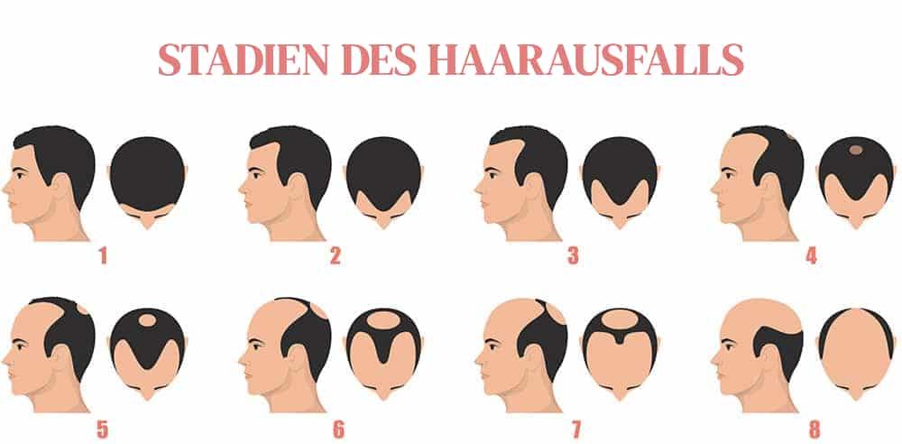 Phasen des Haarausfalls