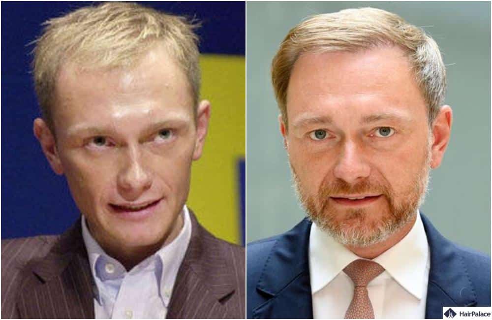 Christian Lindner vorher und nachher haartransplantation