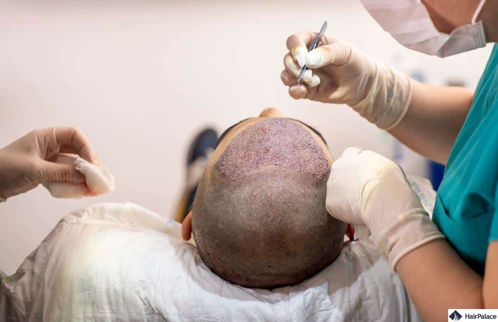 haartransplantation