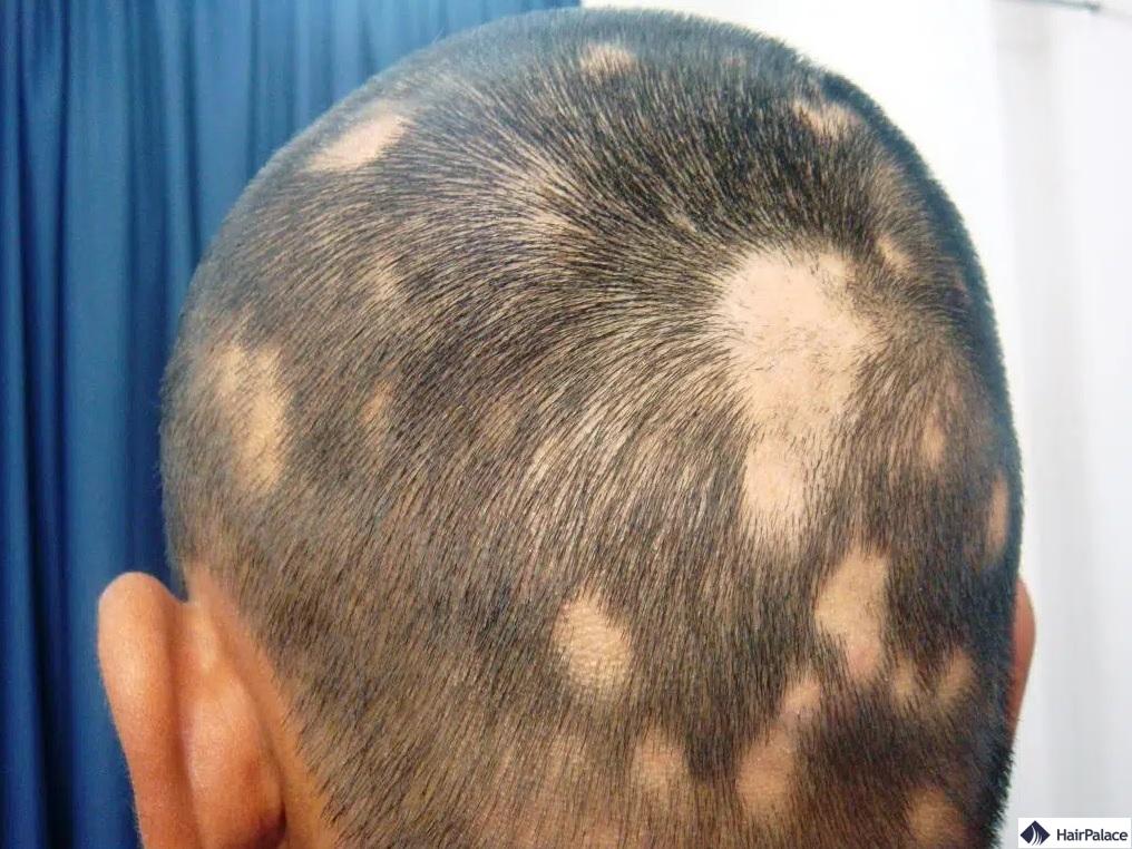 Formen von kreisrundem Haarausfall
