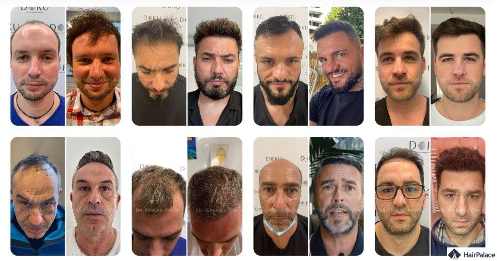 Haartransplantation Ergebnisse von Dr. Serkan Aygin