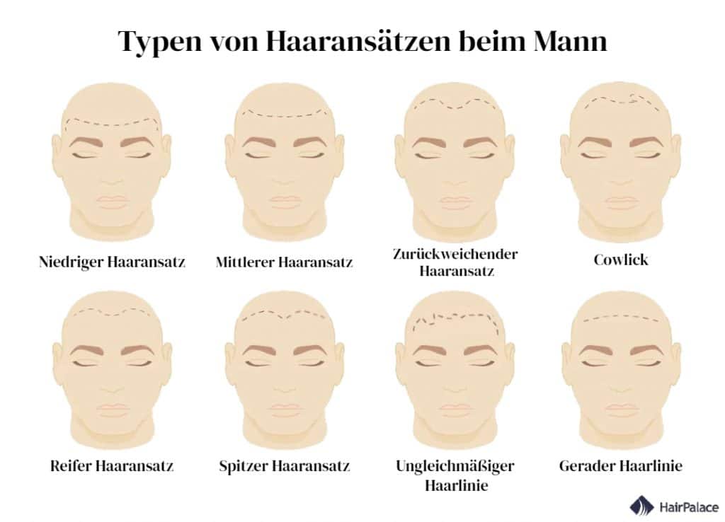 Typen von Haaransätzen beim Mann