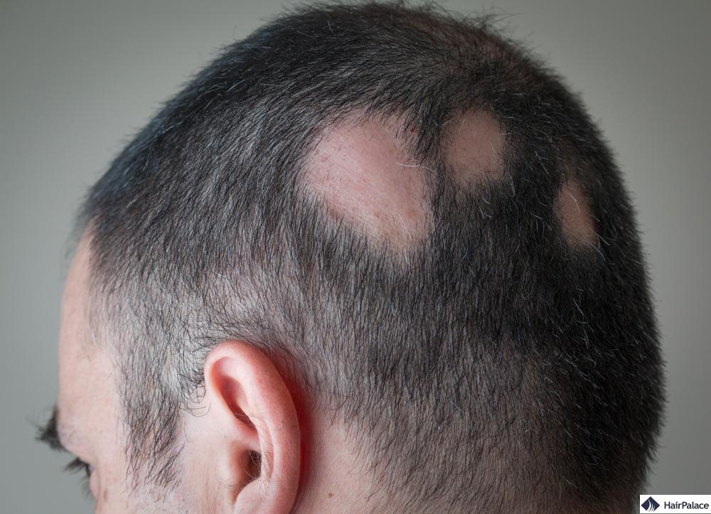 Alopecia areata kann zu diffusem Haarausfall führen