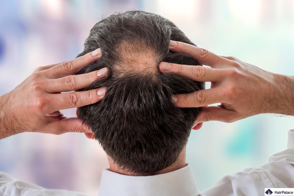 frisuren für männer mit glatze am hinterkopf