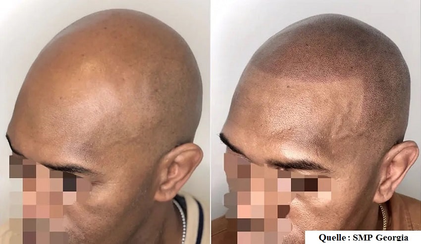 Kopfhaut-Mikropigmentierung Ergebnisse