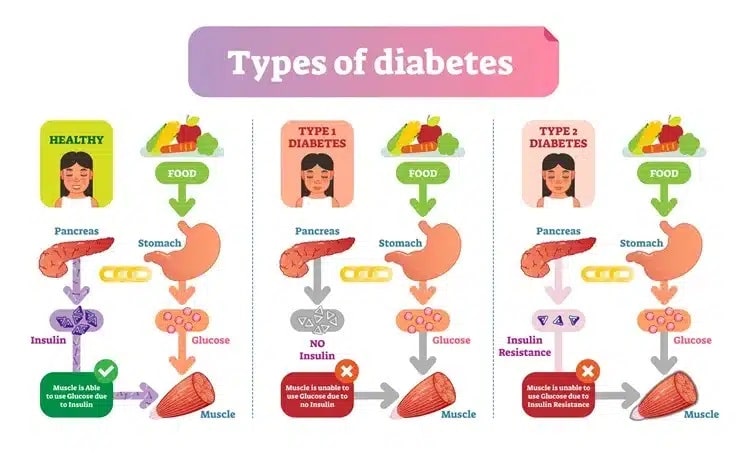 Diabetes-Haarausfall kann sowohl durch Typ 1 als auch durch Typ 2 verursacht werden.