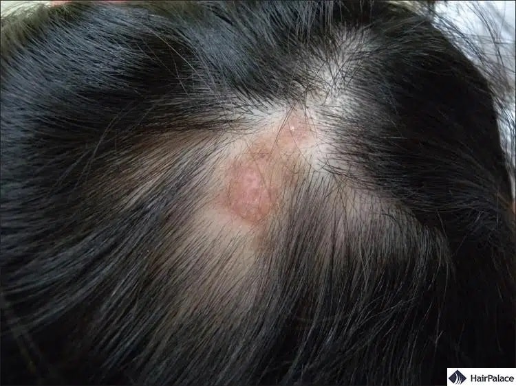 Diskoider Lupus kann dauerhaften Haarausfall verursachen