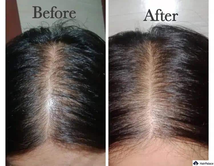 Rosmarinöl für das Haarwachstum vorher und nachher