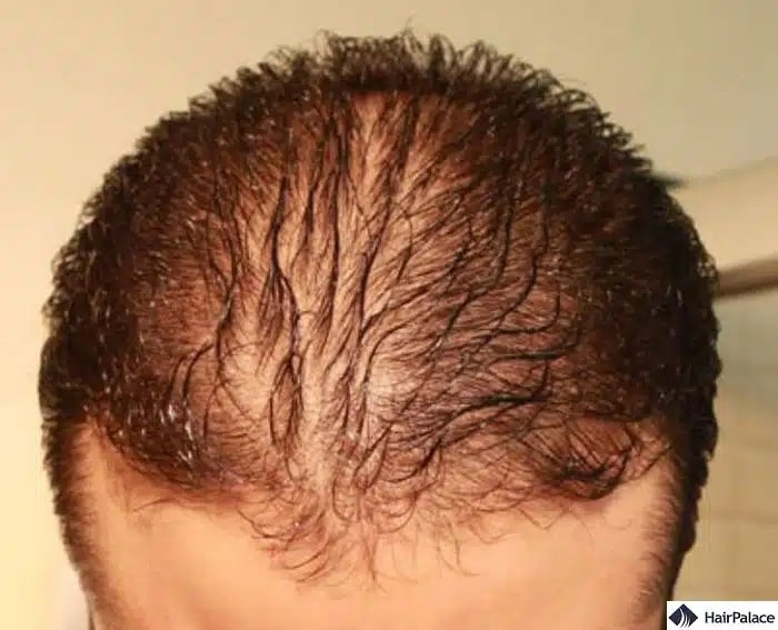 Eine Unterbrechung des Haarwachstumszyklus kann zu Haarausfall führen