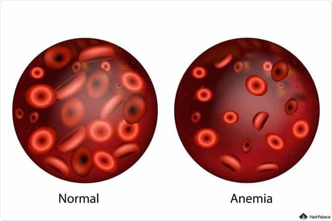 Anämie - Haarausfall aufgrund von Eisenmangel
