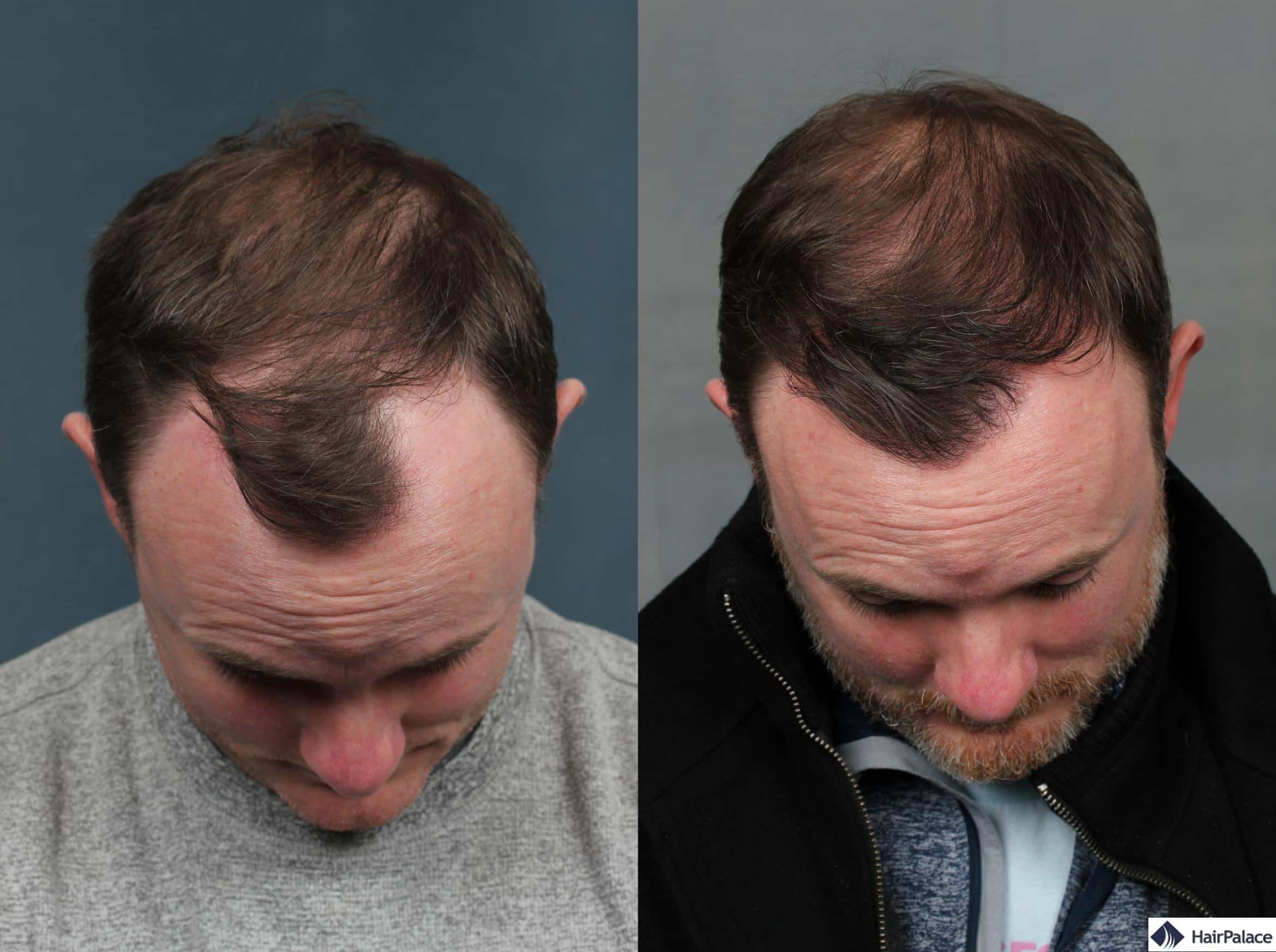neograft Haartransplantation vor und nach dem Foto