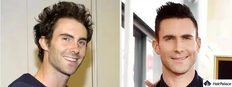 Adam Levine Haartransplantation vorher und nachher