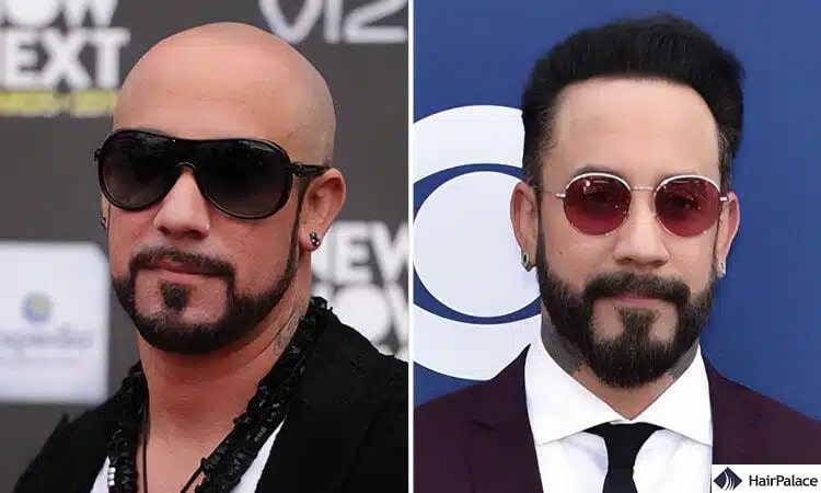 AJ Mclean Haartransplantation vorher und nachher