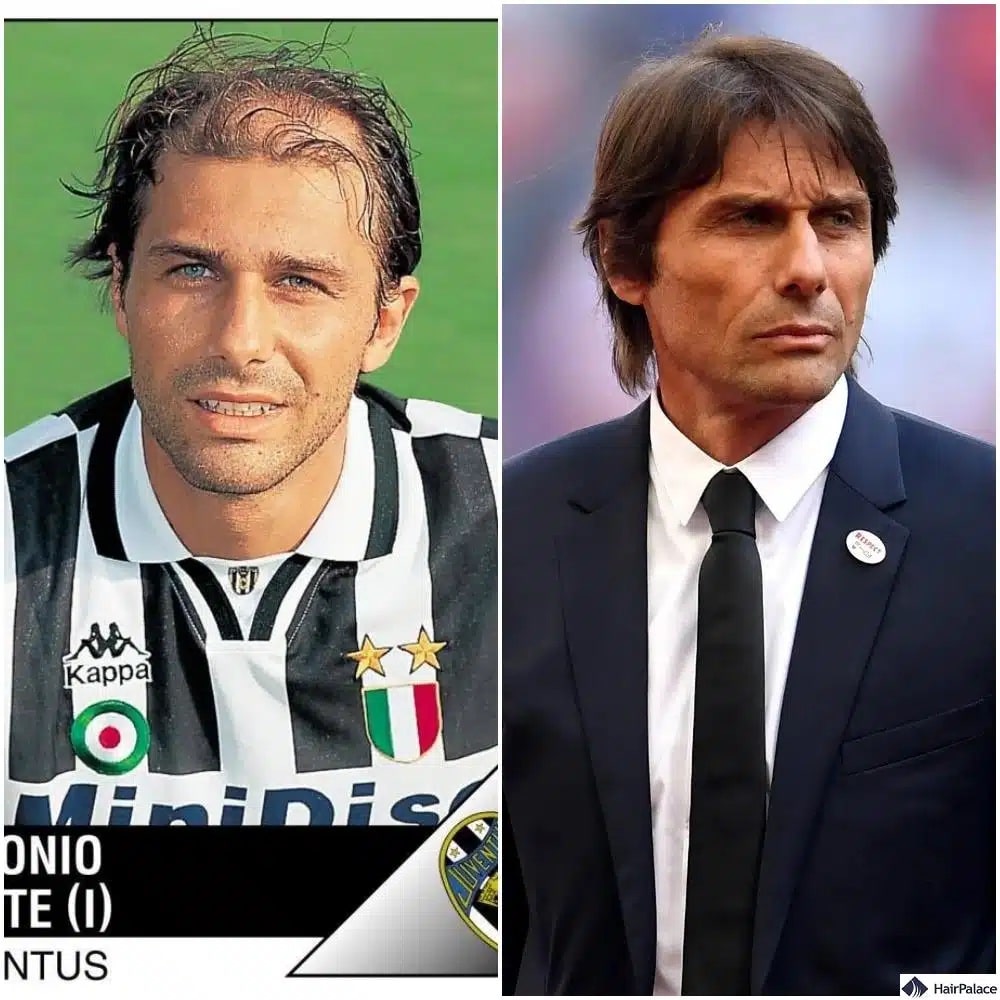 Antonio Conte Haartransplantation vorher und nachher