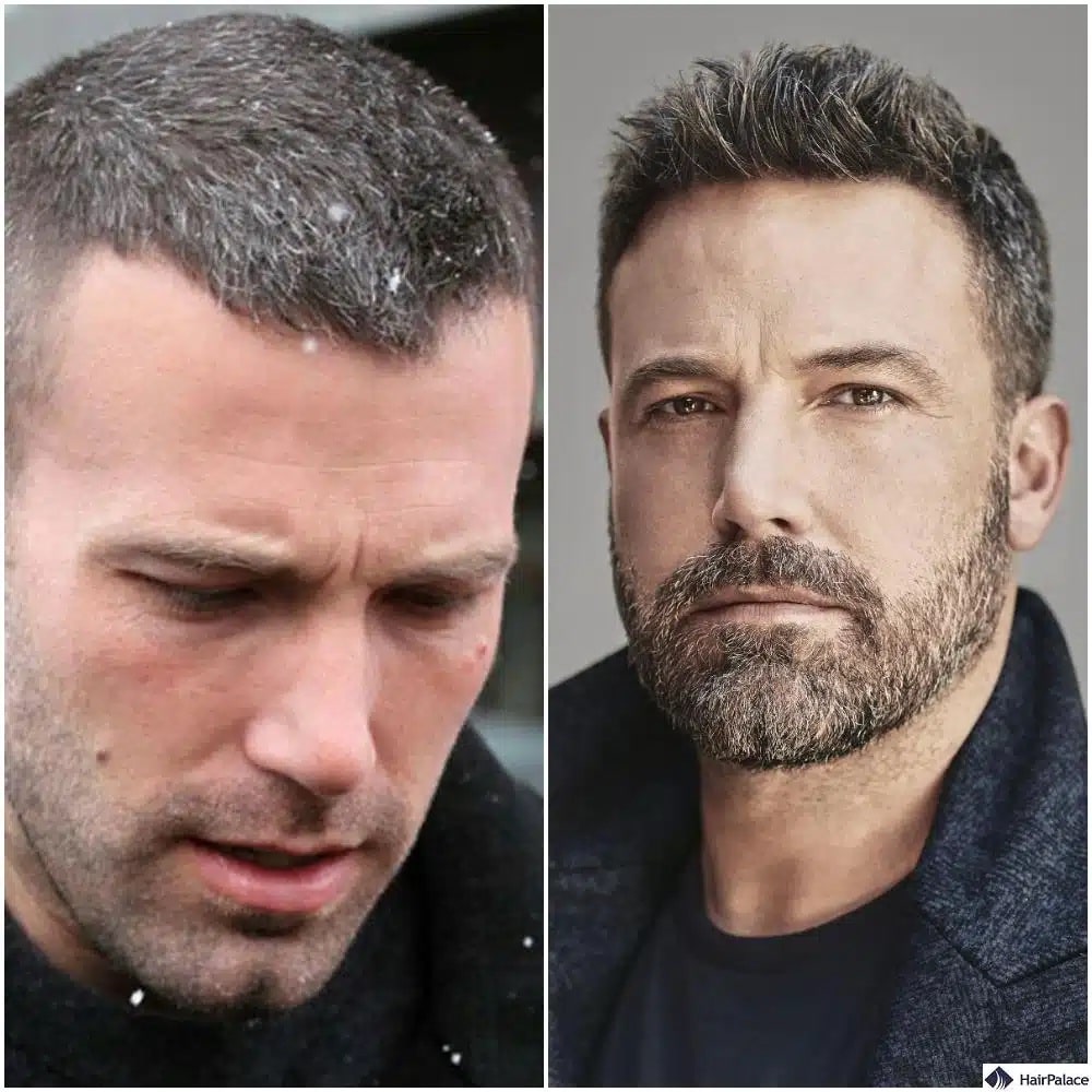 Ben Affleck Haartransplantation vorher und nachher