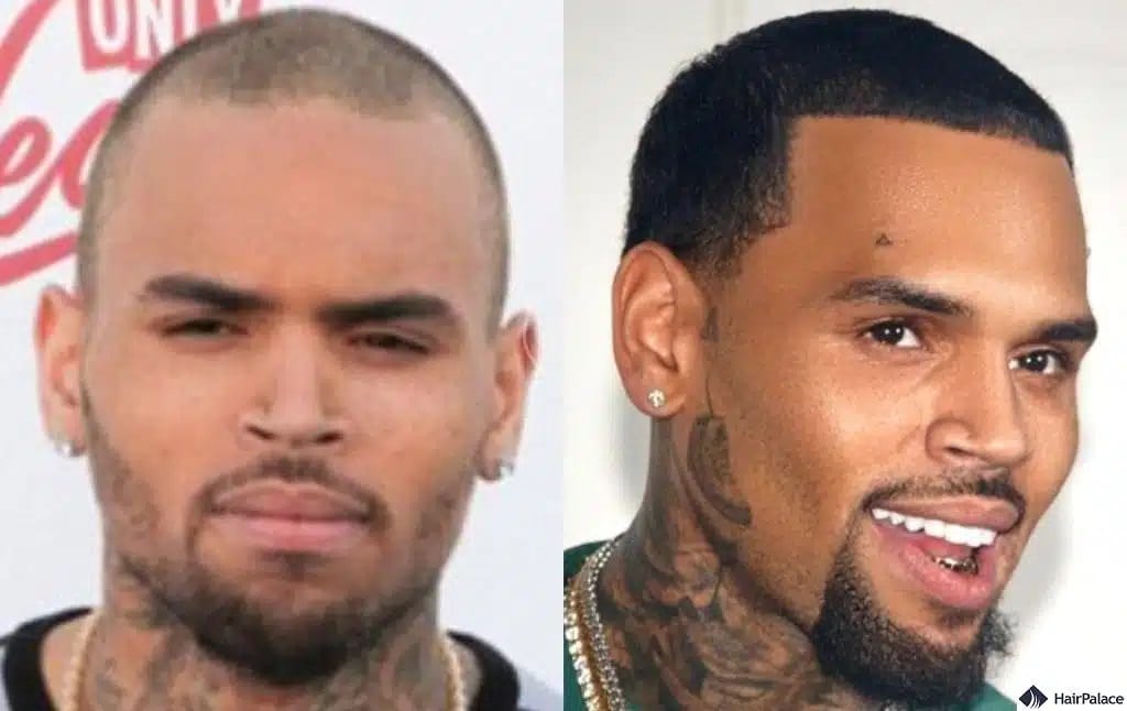 Chris Brown Haartransplantation vorher und nachher