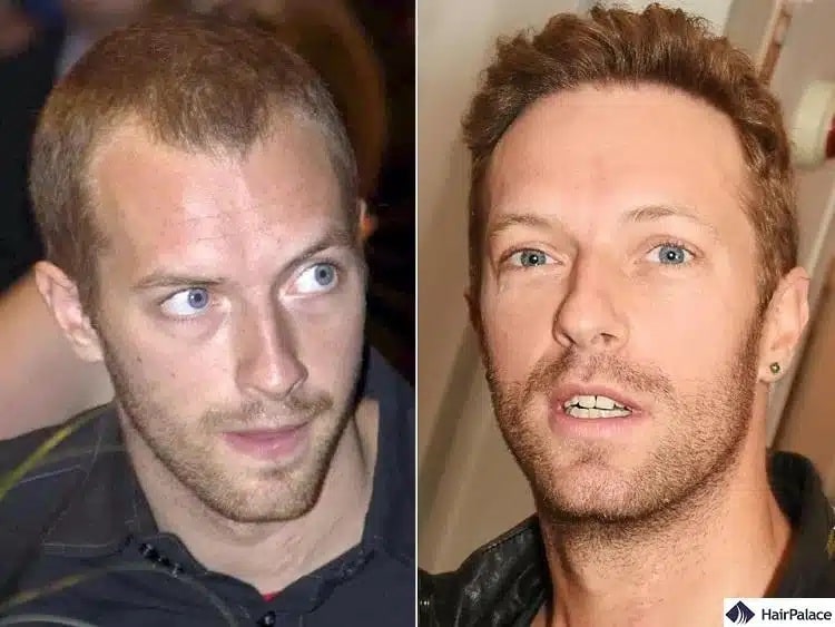 Chris Martin Haartransplantation vorher und nachher