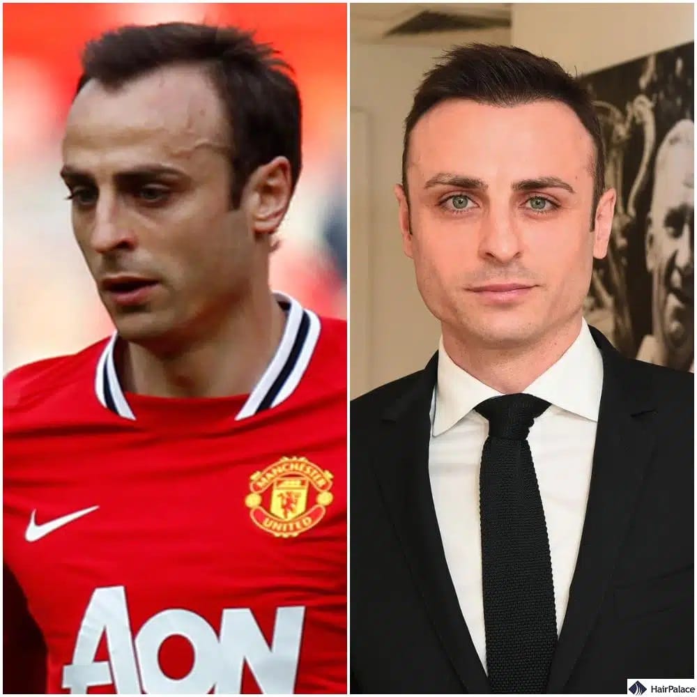 Dimitar Berbatov Haartransplantation vorher und nachher