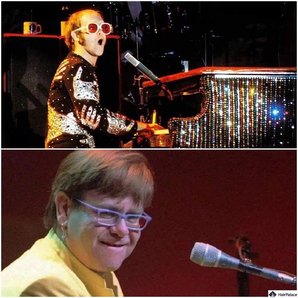 Elton John Haartransplantation vorher und nachher
