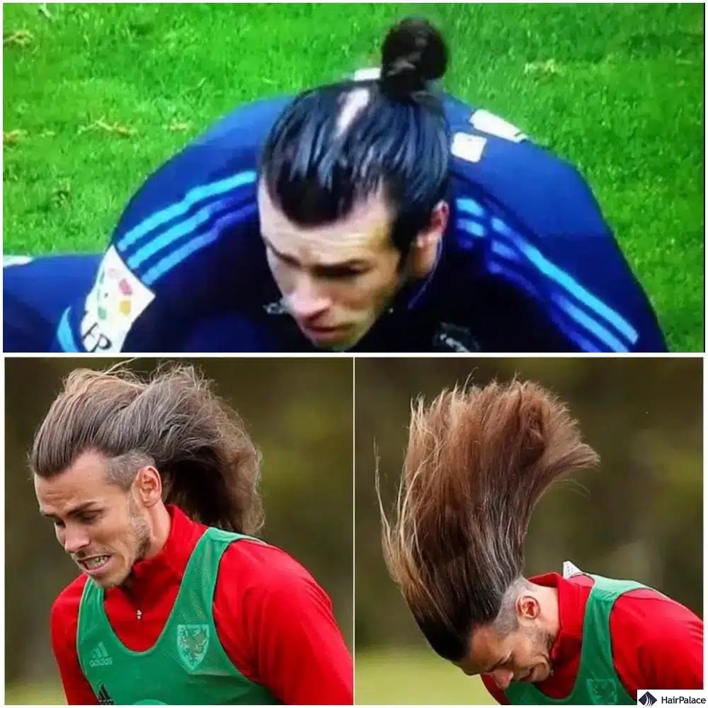Gareth Bale Haartransplantation vorher und nachher