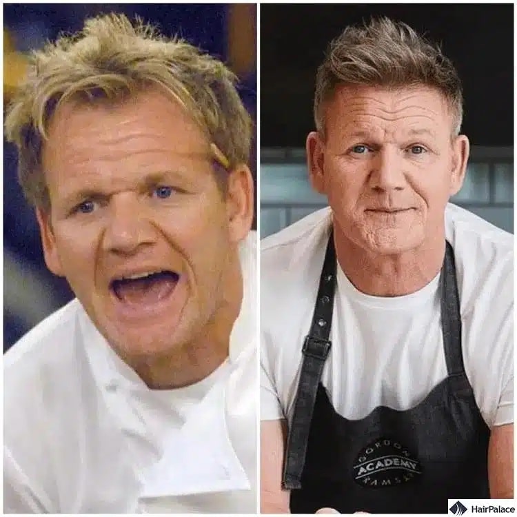 Gordon Ramsay Haartransplantation vorher und nachher