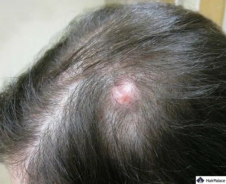 Zysten sind eine gefährliche Nebenwirkung der Haartransplantation
