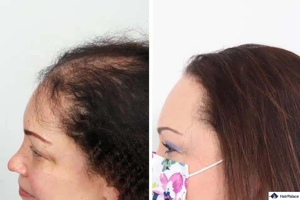 Endergebnisse der weiblichen Haartransplantation