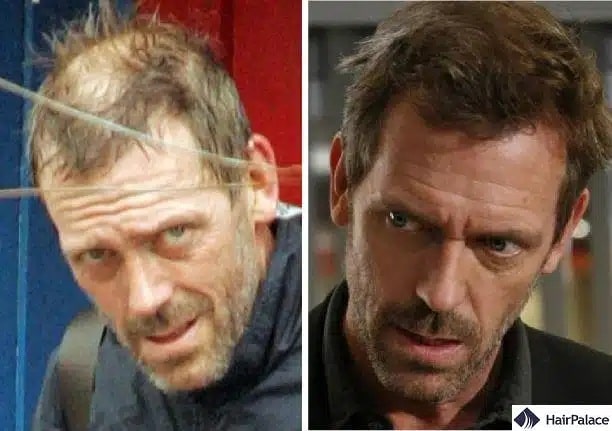 Hugh Laurie Haartransplantation vorher und nachher