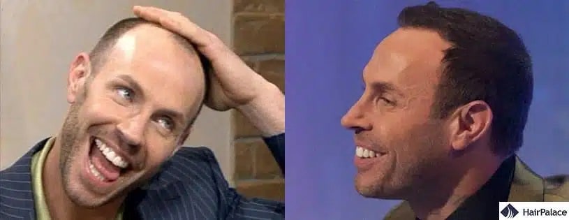 Jason Gardiner Haartransplantation vorher und nachher