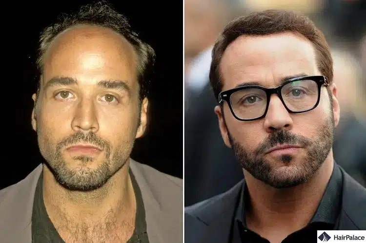 Jeremy Piven Haartransplantation vorher und nachher